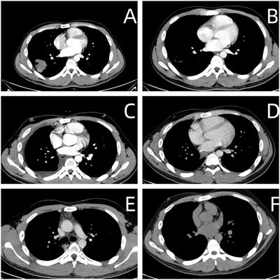 A case report of recurrent testicular germ cell tumor in a patient with a history of primary pulmonary germ cell tumor and a review of the literature